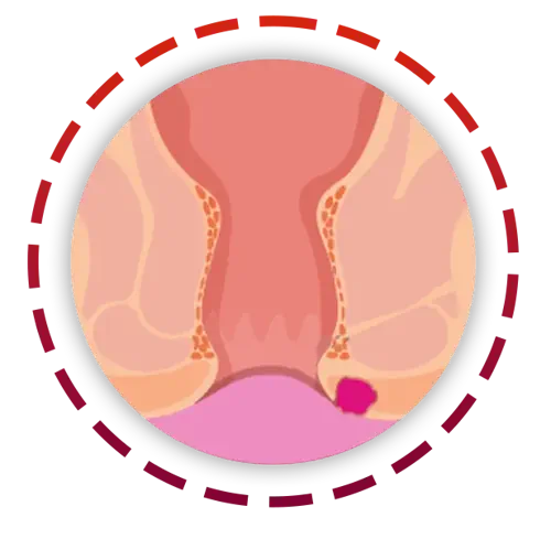 درمان آبسه مقعدی