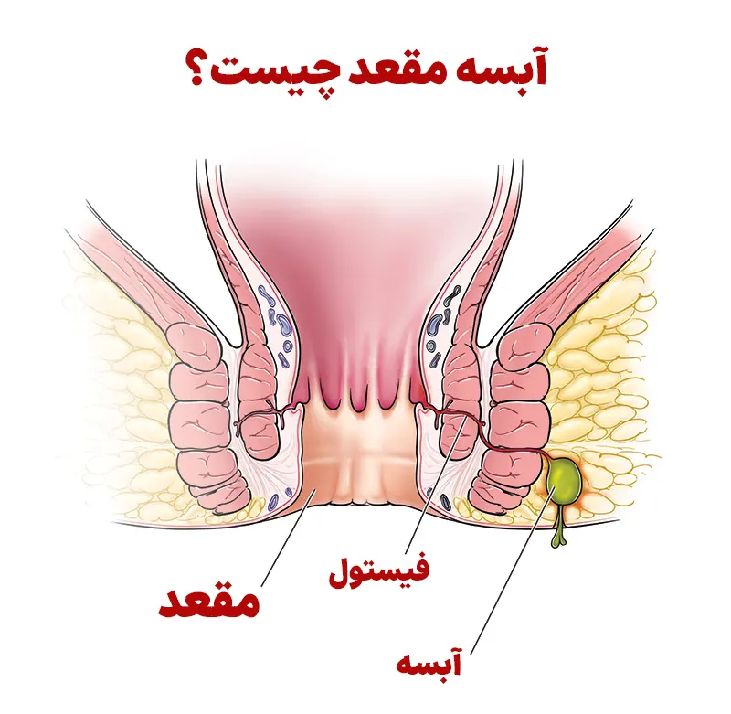 آبسه مقعد