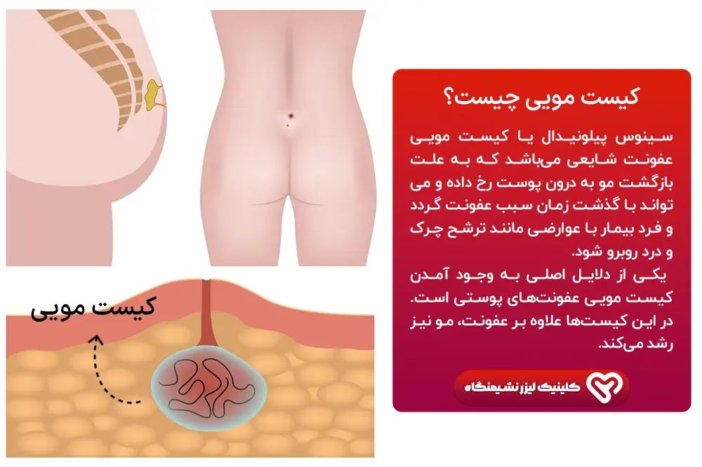 کیست مویی چیست؟